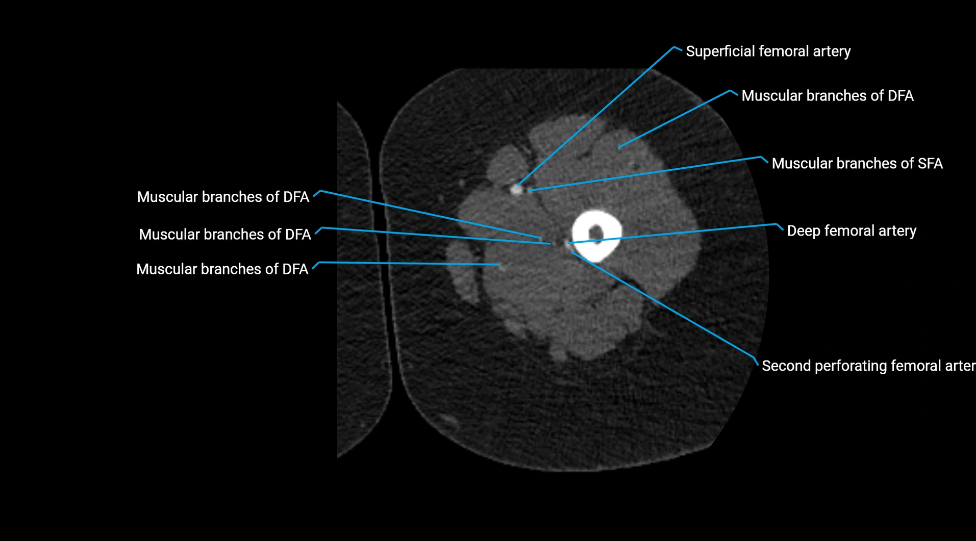 CTA lower limb cross sectional anatomy labelled image _108.webp